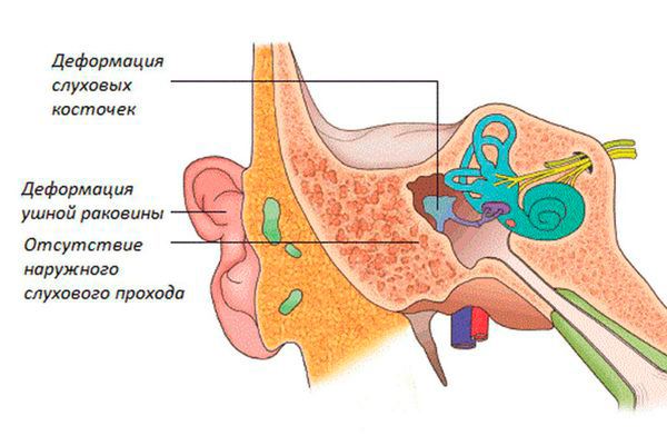 Атрезия слухового прохода затрагивает наружное и среднее ухо Атрезия слухового прохода